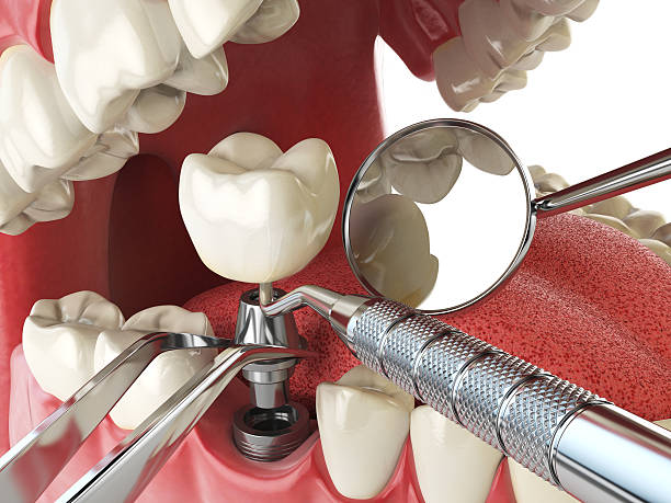 Best Emergency Treatment for Dental Infections or Abscesses in Colorado City, TX